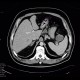 Macrocystic adenoma of pancreas: CT - Computed tomography